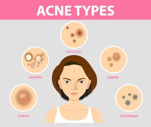 ব্রণ থেকে মুক্তির ১০টি উপায়