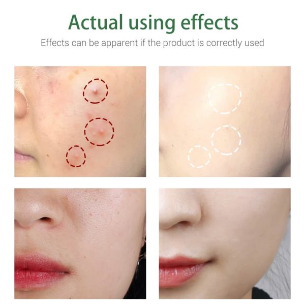 ঘরোয়া পদ্ধতিতে ব্রণ নিরাময়